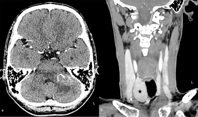 Case report: Triple whammy: Synchronous radiotherapy induced glioblastoma multiforme and papillary thyroid cancer following nasopharyngeal carcinoma